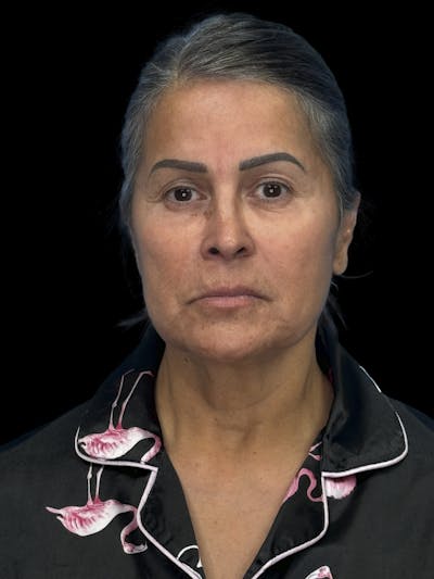 Deep Plane Facelift 50s Before & After Gallery - Patient 347296 - Image 1