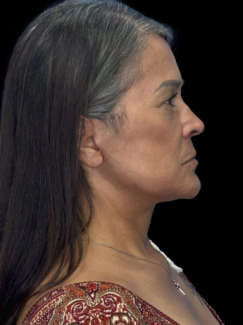 Deep Plane Facelift 50s Before & After Gallery - Patient 347296 - Image 10