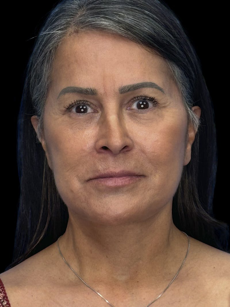 Deep Plane Facelift 50s Before & After Gallery - Patient 347296 - Image 2