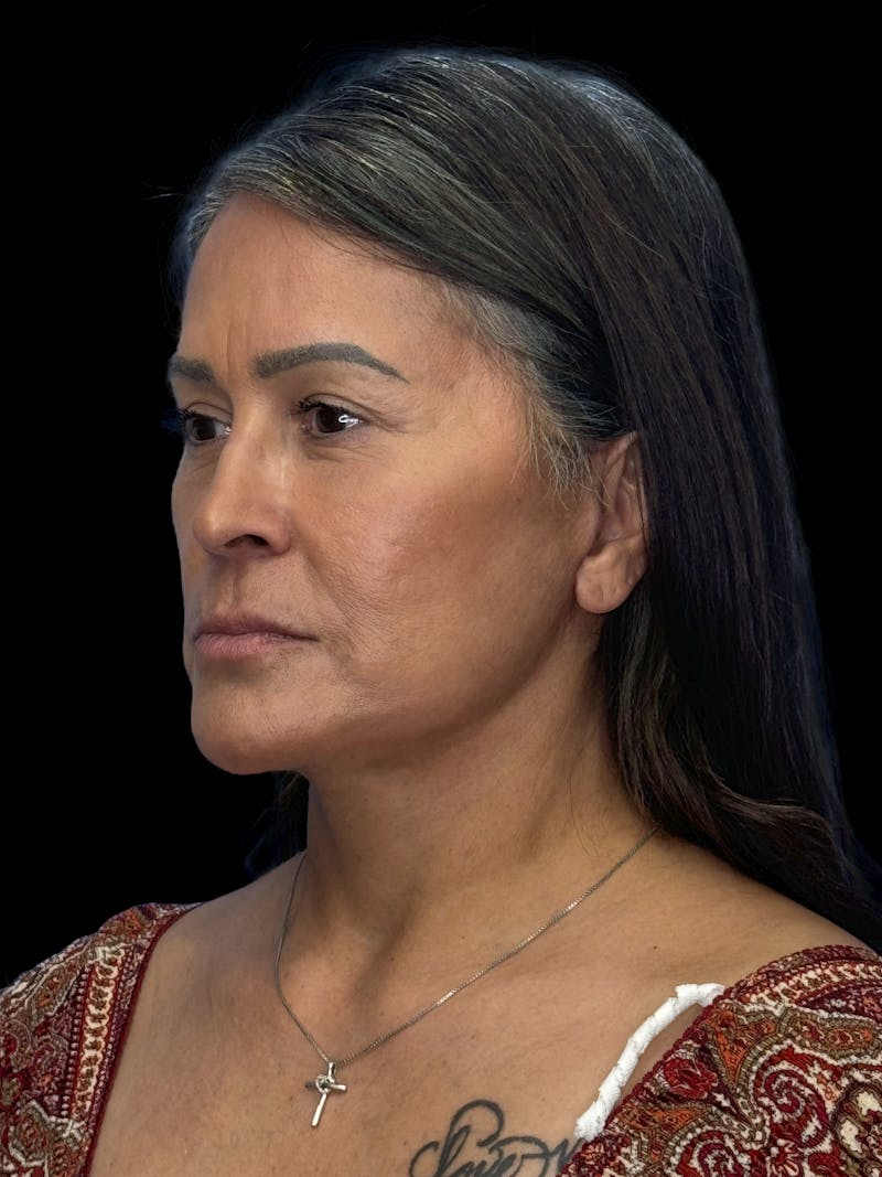 Deep Plane Facelift 50s Before & After Gallery - Patient 347296 - Image 4