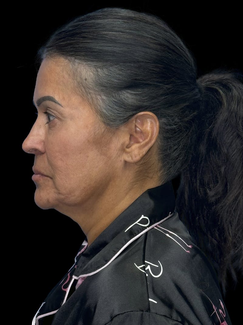 Deep Plane Facelift 50s Before & After Gallery - Patient 347296 - Image 5