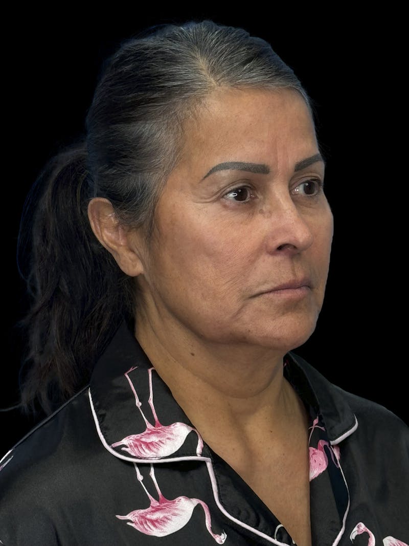 Deep Plane Facelift 50s Before & After Gallery - Patient 347296 - Image 7