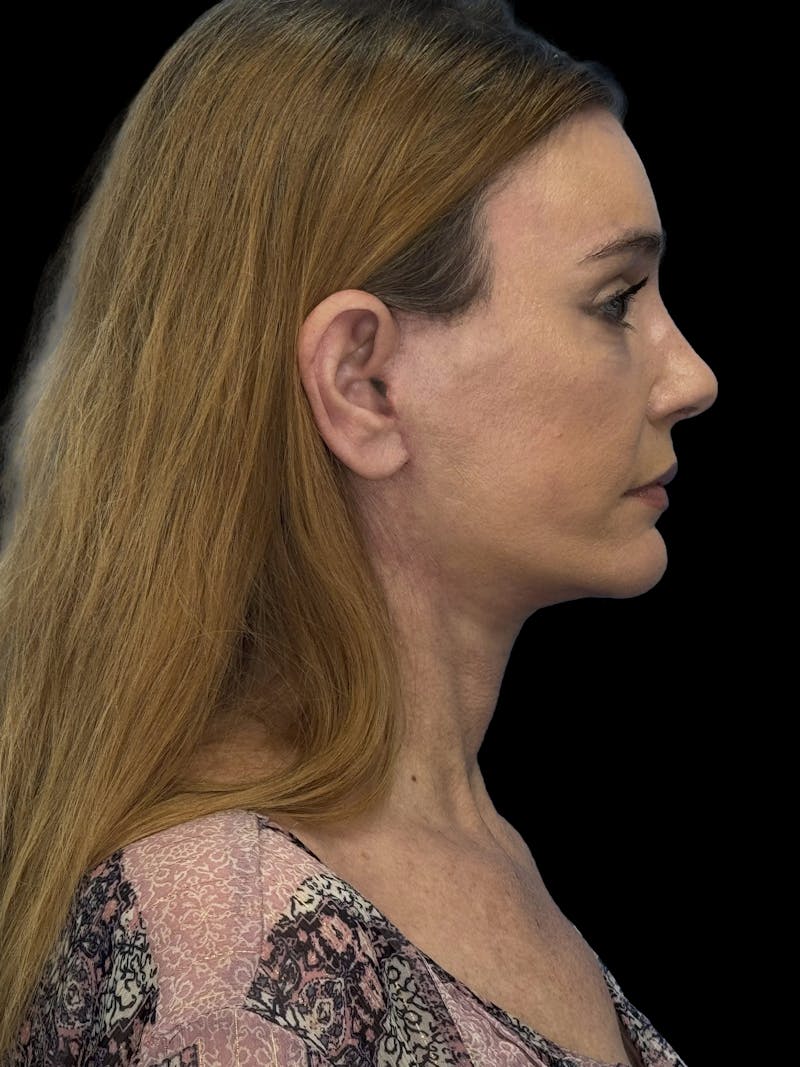 Deep Plane Facelift 50s Before & After Gallery - Patient 121791 - Image 6