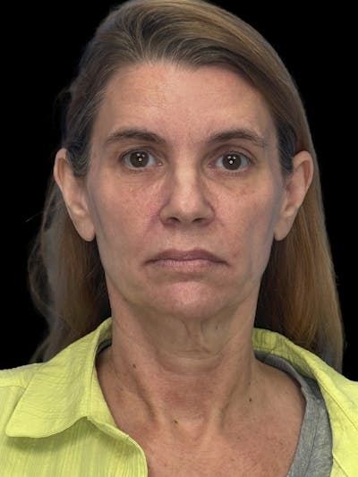 Deep Plane Facelift 50s Before & After Gallery - Patient 121791 - Image 1