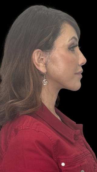 Deep Plane Facelift 50s Before & After Gallery - Patient 210718 - Image 14
