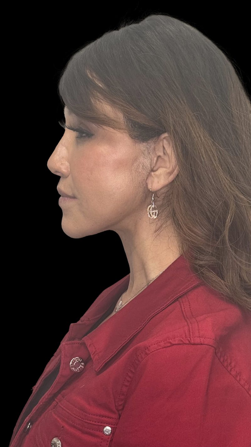 ContourLift Before & After Gallery - Patient 227072 - Image 6