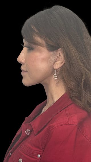 Deep Plane Facelift 50s Before & After Gallery - Patient 210718 - Image 8