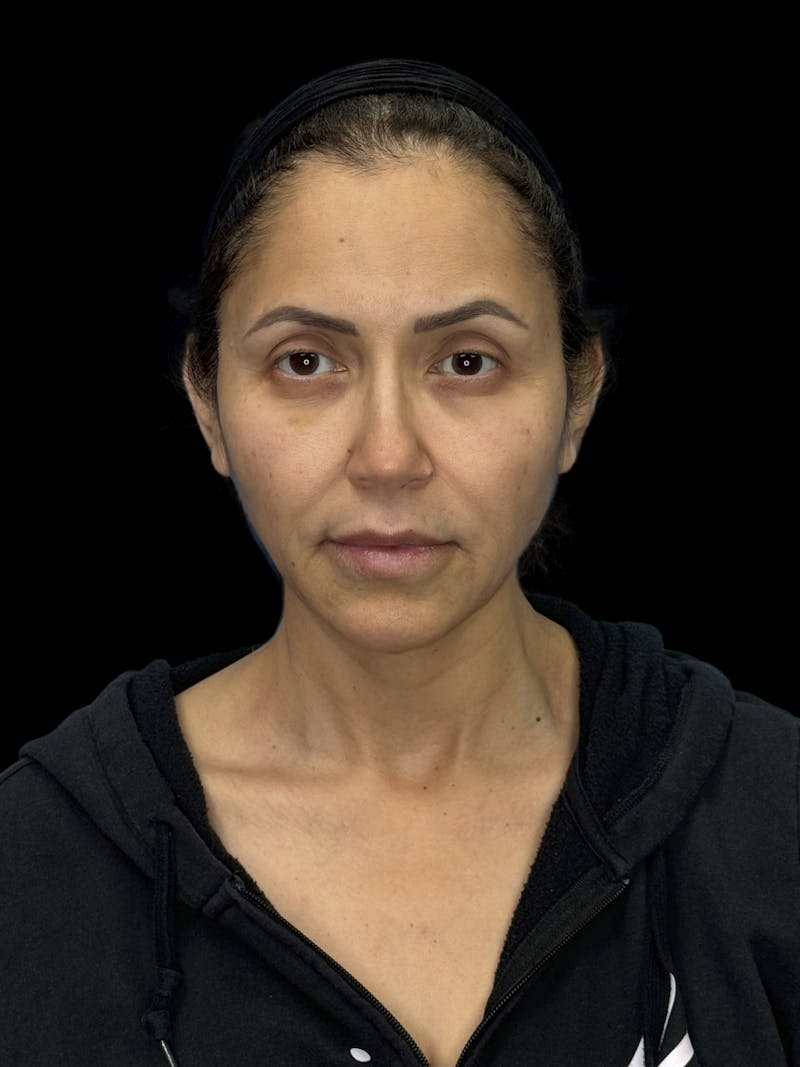 Deep Plane Facelift 50s Before & After Gallery - Patient 210718 - Image 1