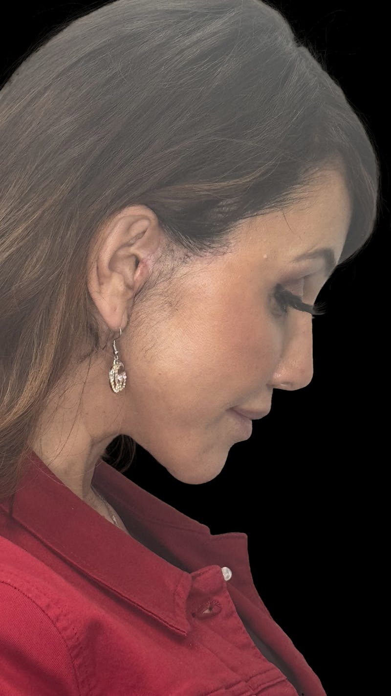 Deep Plane Facelift 50s Before & After Gallery - Patient 210718 - Image 12