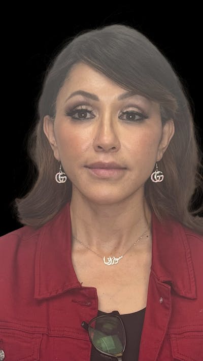 Deep Plane Facelift 50s Before & After Gallery - Patient 210718 - Image 2