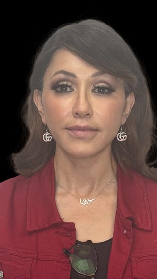 Deep Plane Facelift 50s Before & After Gallery - Patient 210718 - Image 2