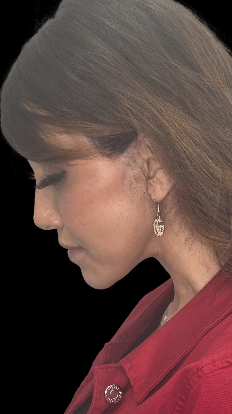 ContourLift Before & After Gallery - Patient 227072 - Image 12