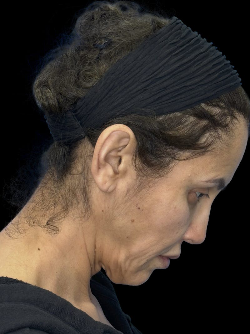 Deep Plane Facelift 50s Before & After Gallery - Patient 210718 - Image 11