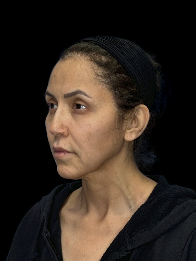 Deep Plane Facelift 50s Before & After Gallery - Patient 210718 - Image 3