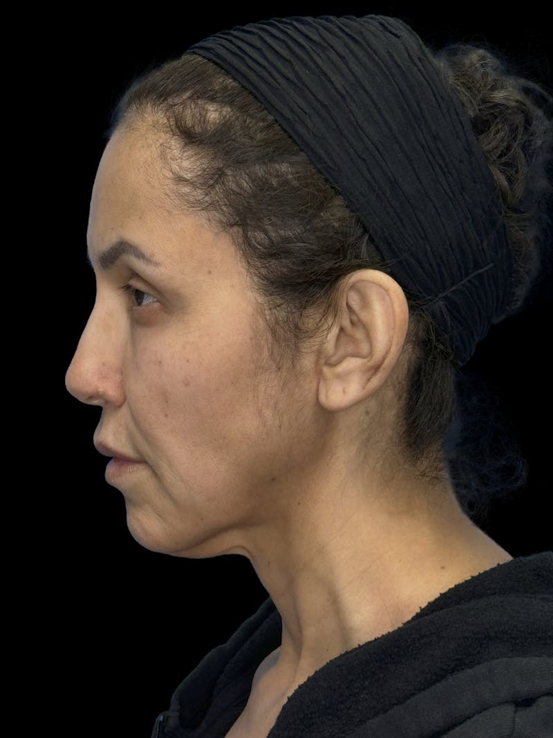Deep Plane Facelift 50s Before & After Gallery - Patient 210718 - Image 7