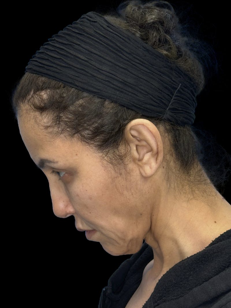 Deep Plane Facelift 50s Before & After Gallery - Patient 210718 - Image 5