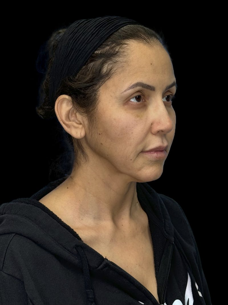 Deep Plane Facelift 50s Before & After Gallery - Patient 210718 - Image 9