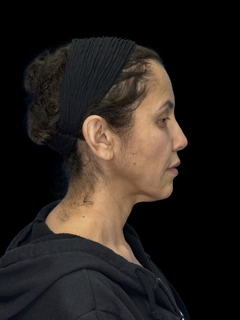 Deep Plane Facelift 50s Before & After Gallery - Patient 210718 - Image 13