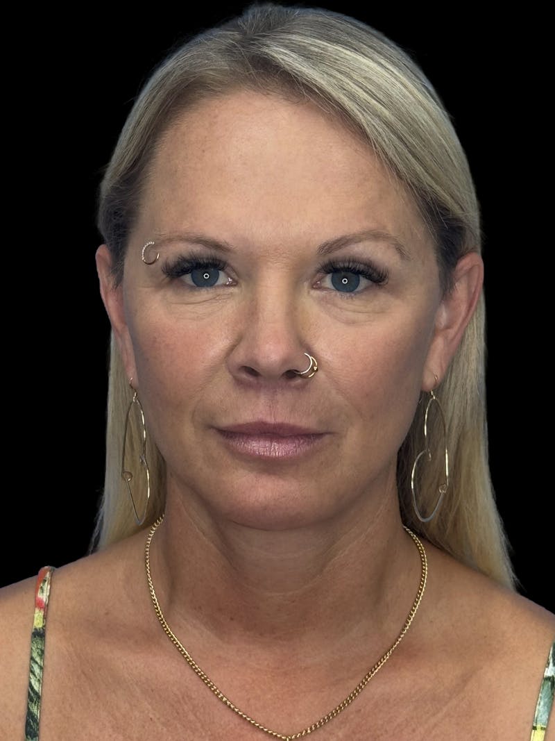 Deep Plane Facelift 50s Before & After Gallery - Patient 307772 - Image 2