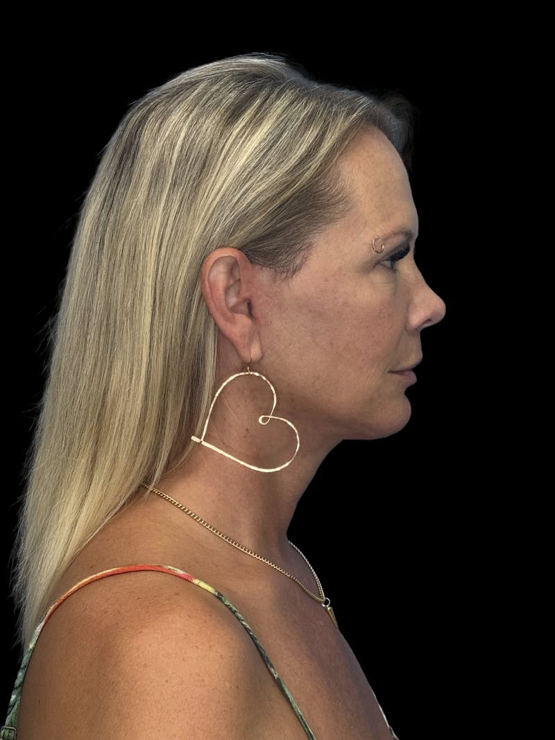 Deep Plane Facelift 50s Before & After Gallery - Patient 307772 - Image 12