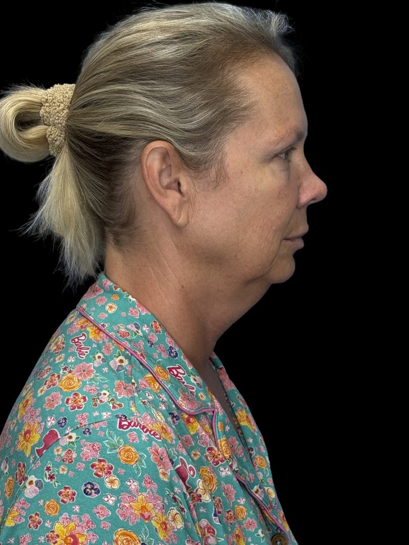 Deep Plane Facelift 50s Before & After Gallery - Patient 307772 - Image 11