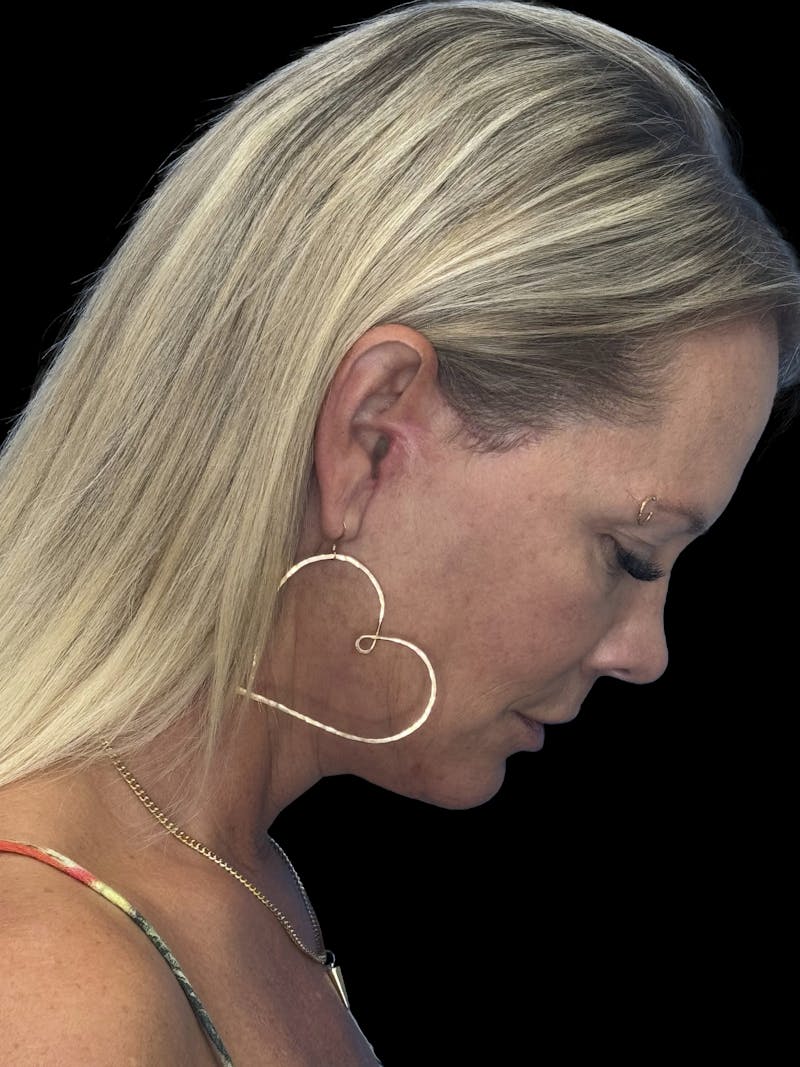 Deep Plane Facelift 50s Before & After Gallery - Patient 307772 - Image 10