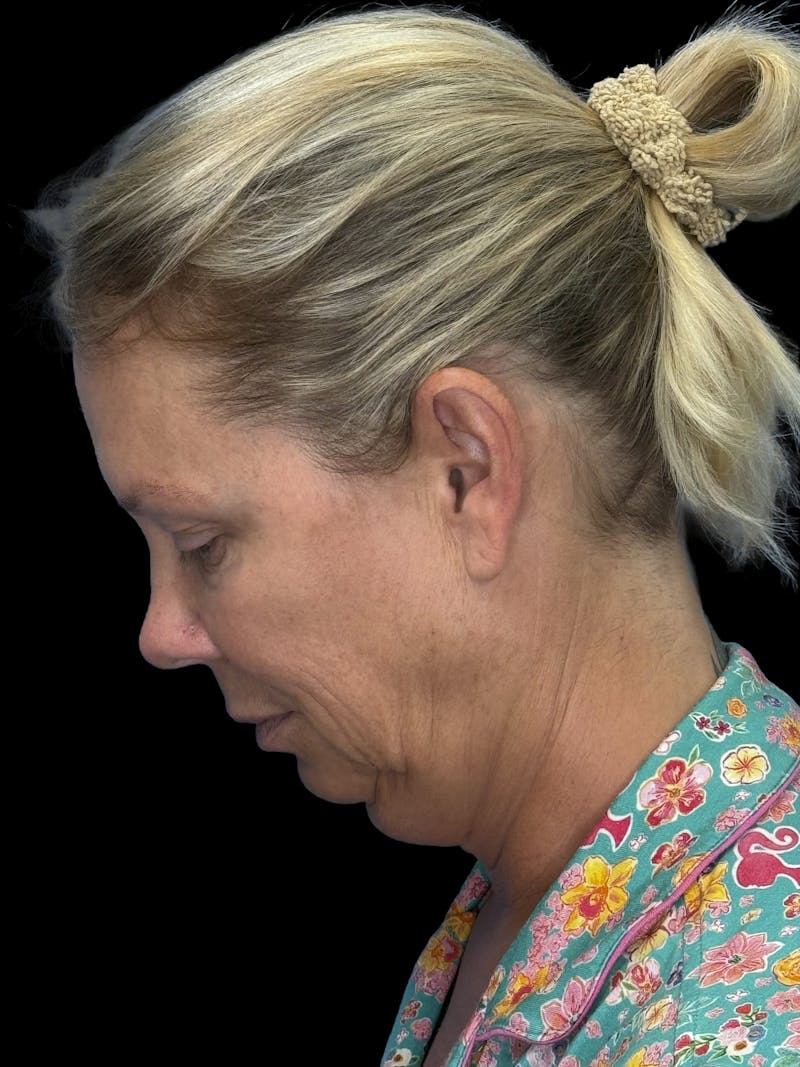 Deep Plane Facelift 50s Before & After Gallery - Patient 307772 - Image 5