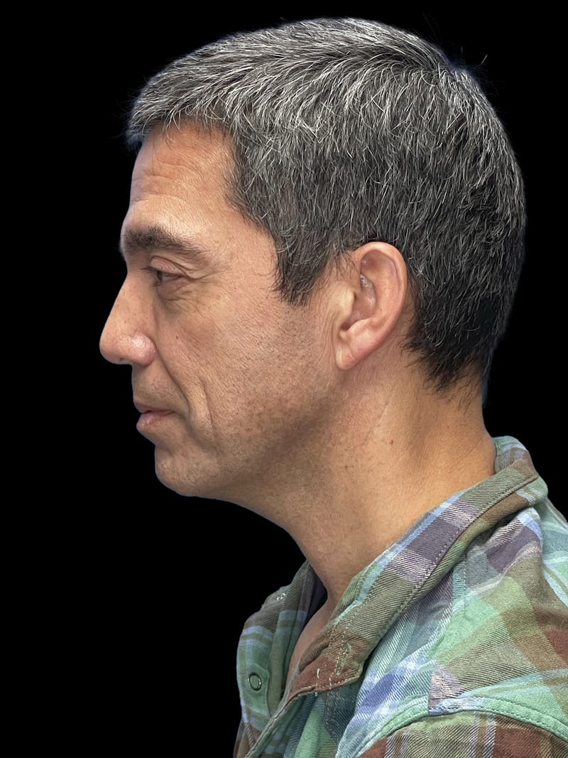 Cheek Implant Before & After Gallery - Patient 213713 - Image 5