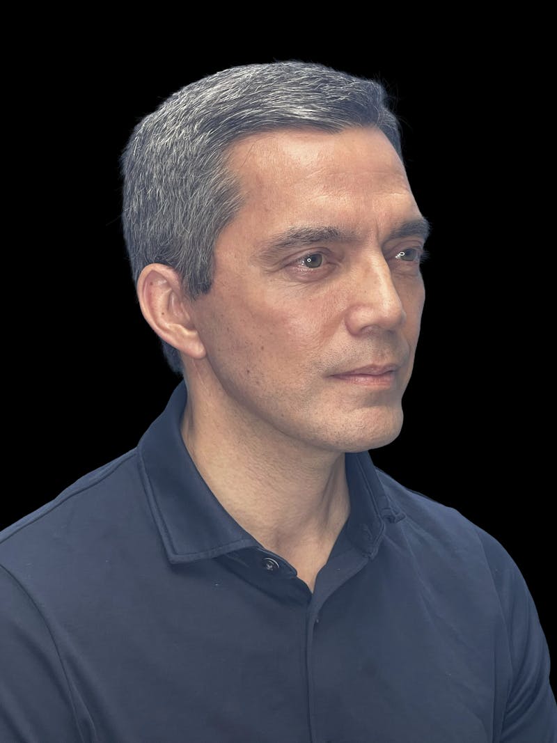 Cheek Implant Before & After Gallery - Patient 213713 - Image 8