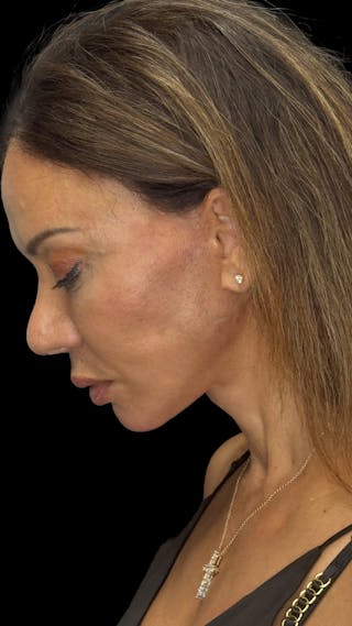 Deep Plane Facelift 50s Before & After Gallery - Patient 225457 - Image 6