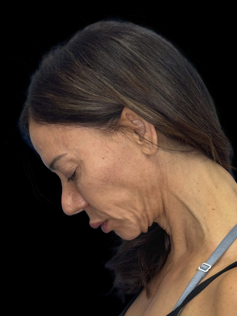 ContourLift Before & After Gallery - Patient 195981 - Image 5