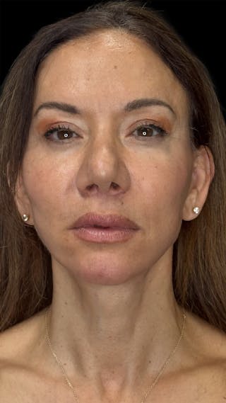 Deep Plane Facelift 50s Before & After Gallery - Patient 225457 - Image 2