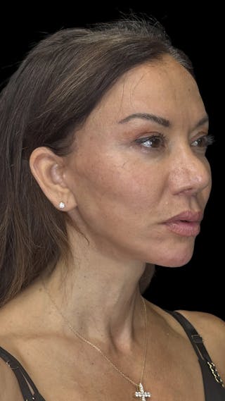 Deep Plane Facelift 50s Before & After Gallery - Patient 225457 - Image 8