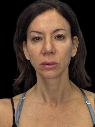 Deep Plane Facelift 50s Before & After Gallery - Patient 225457 - Image 1