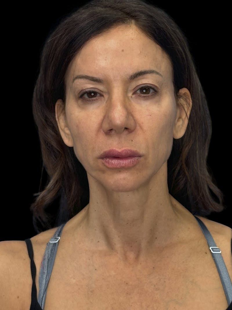 ContourLift Before & After Gallery - Patient 195981 - Image 1