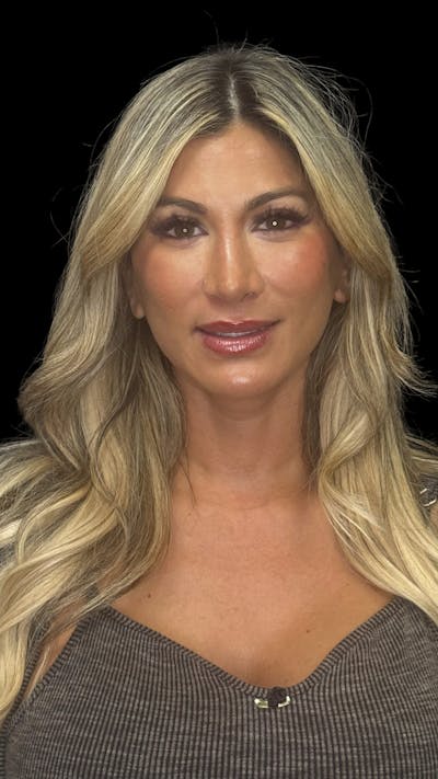 Deep Plane Facelift 40s Before & After Gallery - Patient 744670 - Image 2