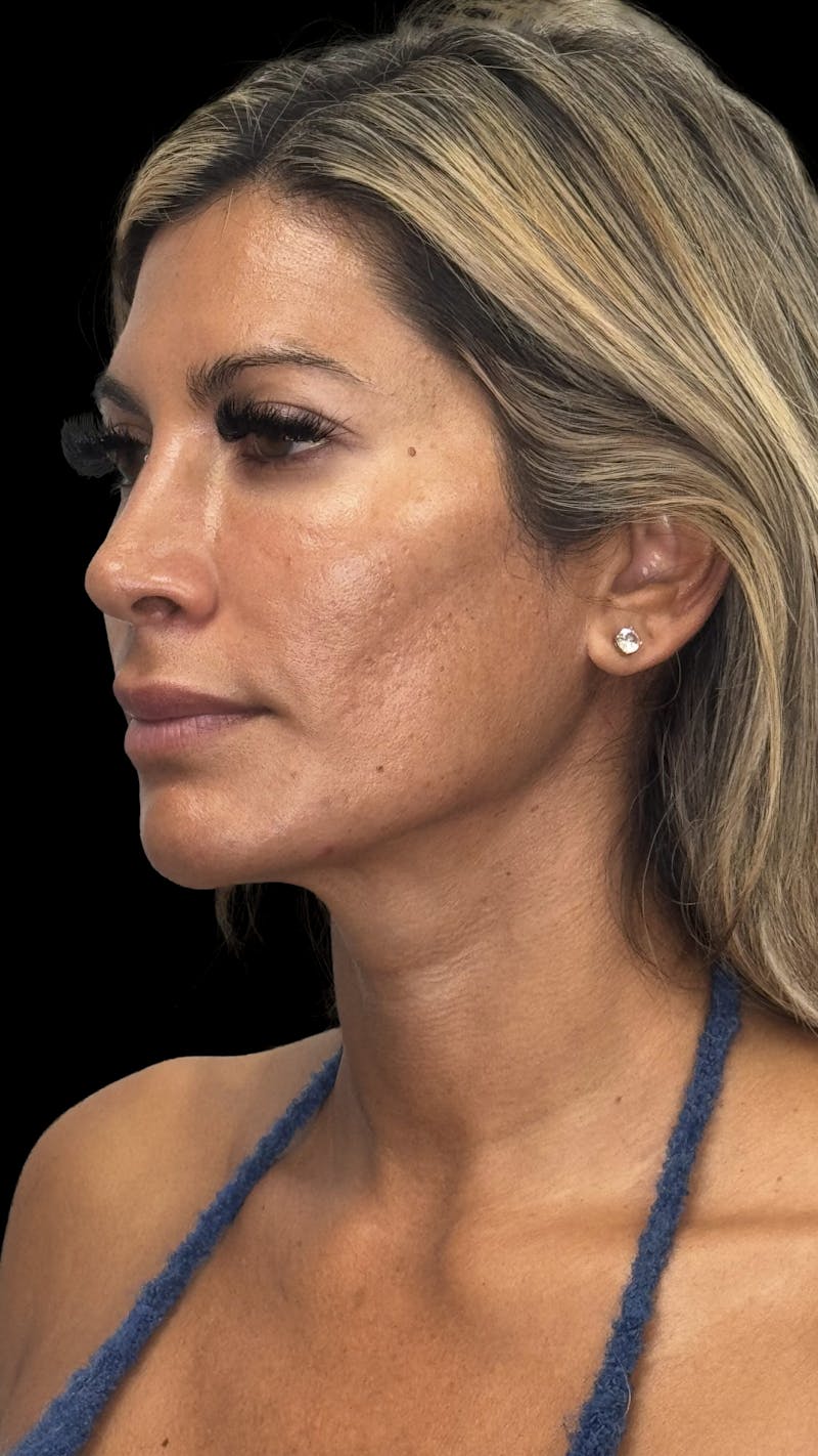 Deep Plane Facelift 40s Before & After Gallery - Patient 744670 - Image 3