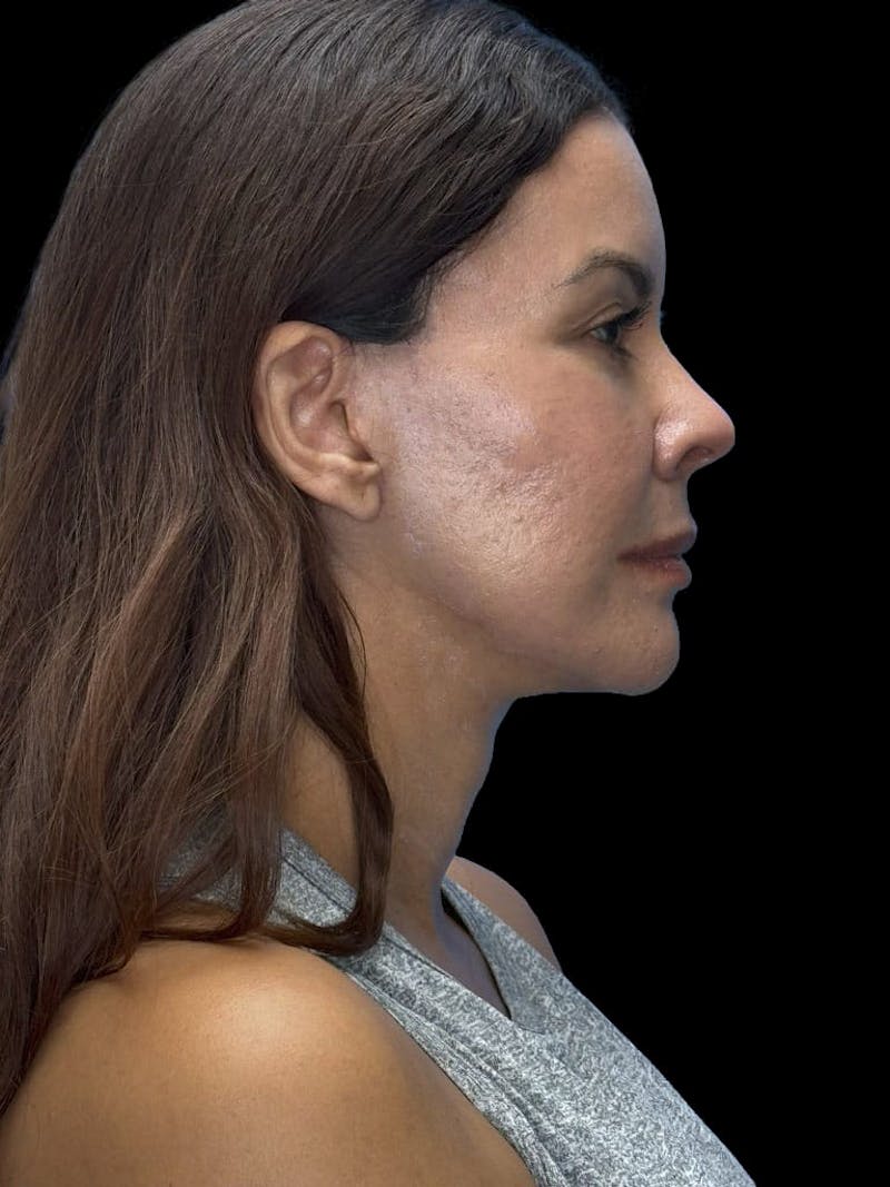 Deep Plane Facelift 40s Before & After Gallery - Patient 426925 - Image 6