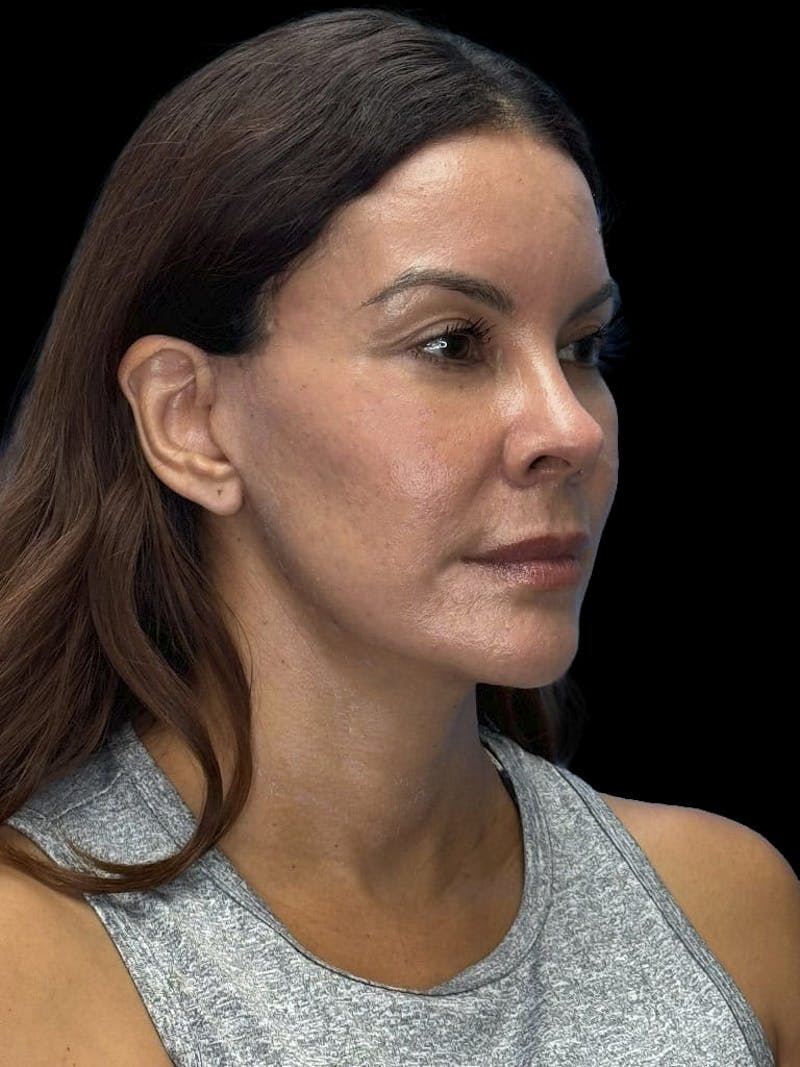 Deep Plane Facelift 40s Before & After Gallery - Patient 426925 - Image 4