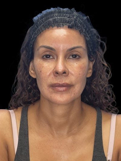 Deep Plane Facelift 40s Before & After Gallery - Patient 426925 - Image 1