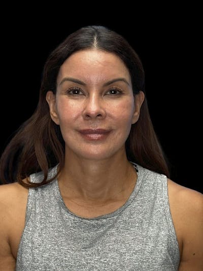 Deep Plane Facelift 40s Before & After Gallery - Patient 426925 - Image 2