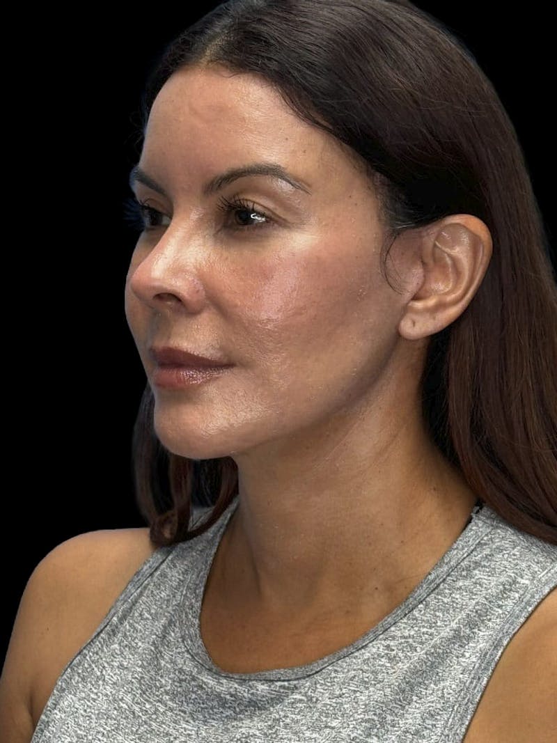 Deep Plane Facelift 40s Before & After Gallery - Patient 426925 - Image 8