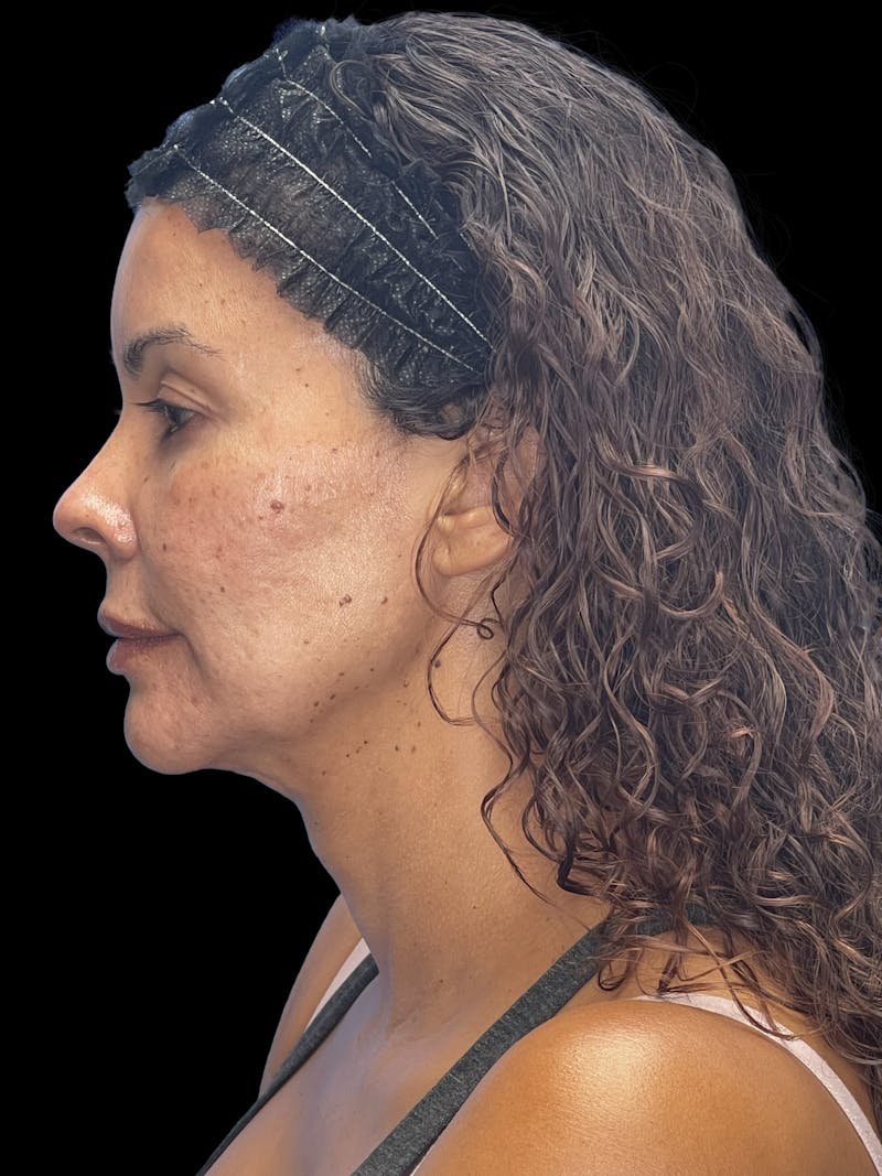 Deep Plane Facelift 40s Before & After Gallery - Patient 426925 - Image 9