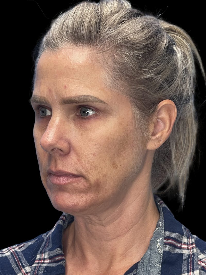 Deep Plane Facelift 40s Before & After Gallery - Patient 319525 - Image 7