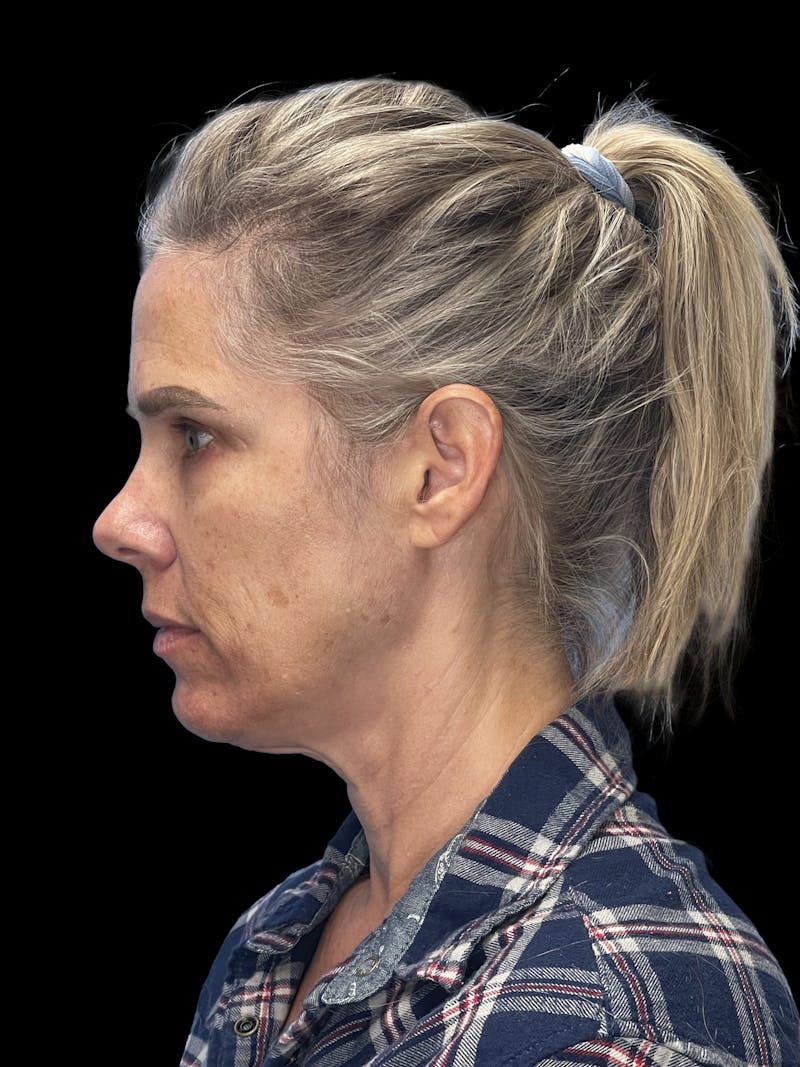 Deep Plane Facelift 40s Before & After Gallery - Patient 319525 - Image 9