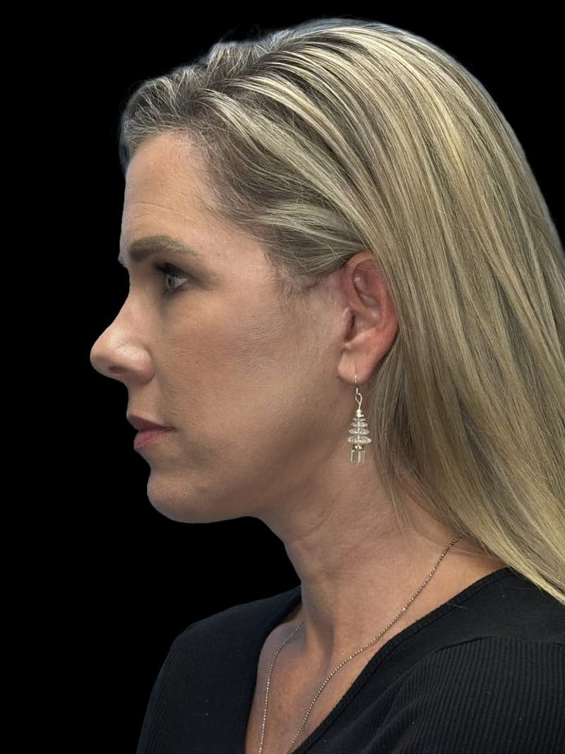 Deep Plane Facelift 40s Before & After Gallery - Patient 319525 - Image 10
