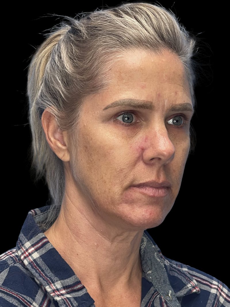 Deep Plane Facelift 40s Before & After Gallery - Patient 319525 - Image 3