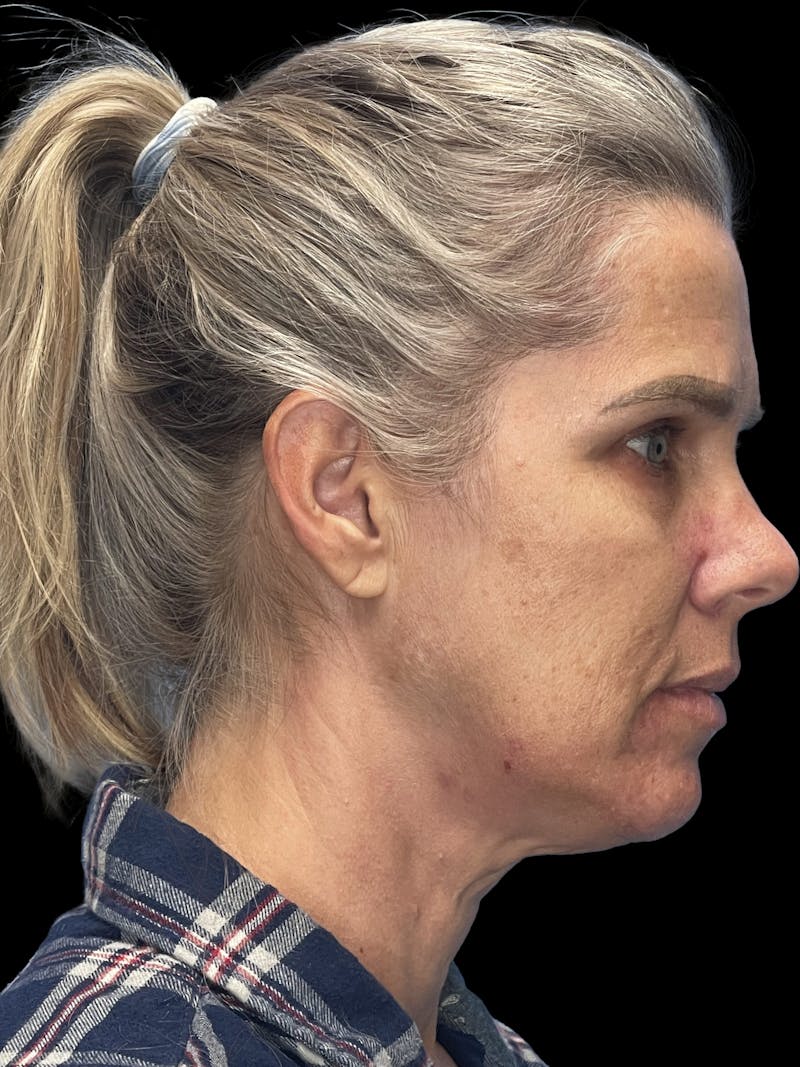 Deep Plane Facelift 40s Before & After Gallery - Patient 319525 - Image 5