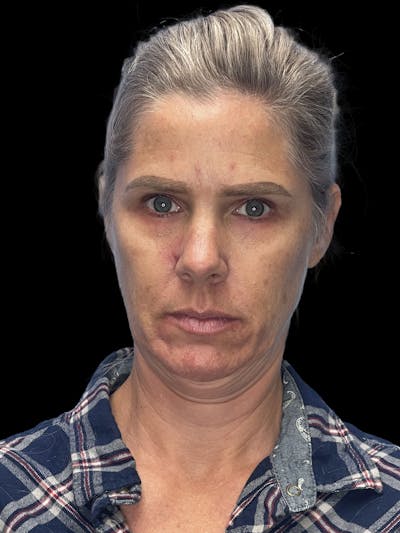 Deep Plane Facelift 40s Before & After Gallery - Patient 319525 - Image 1
