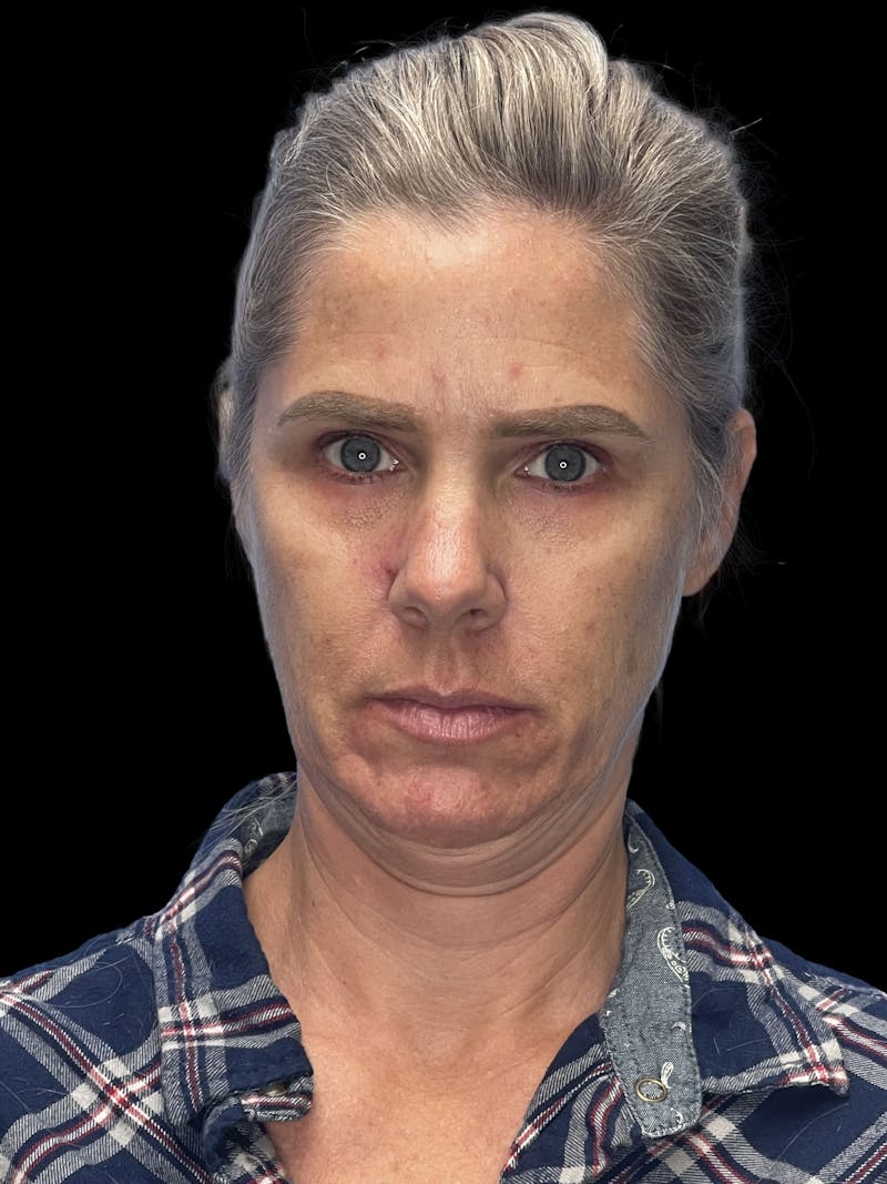 Deep Plane Facelift 40s Before & After Gallery - Patient 319525 - Image 1